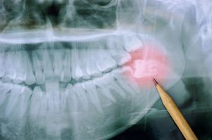 wisdom teeth removal haberfield